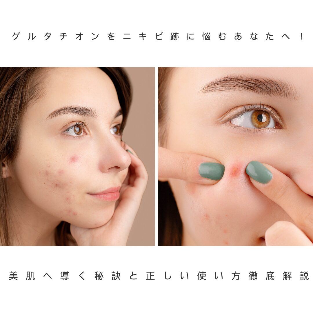 グルタチオン ニキビ跡